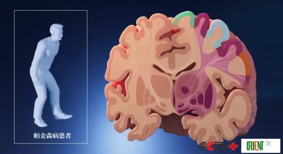 Китайские учёные выявили нейронную сеть, лежащую в основе болезни Паркинсона